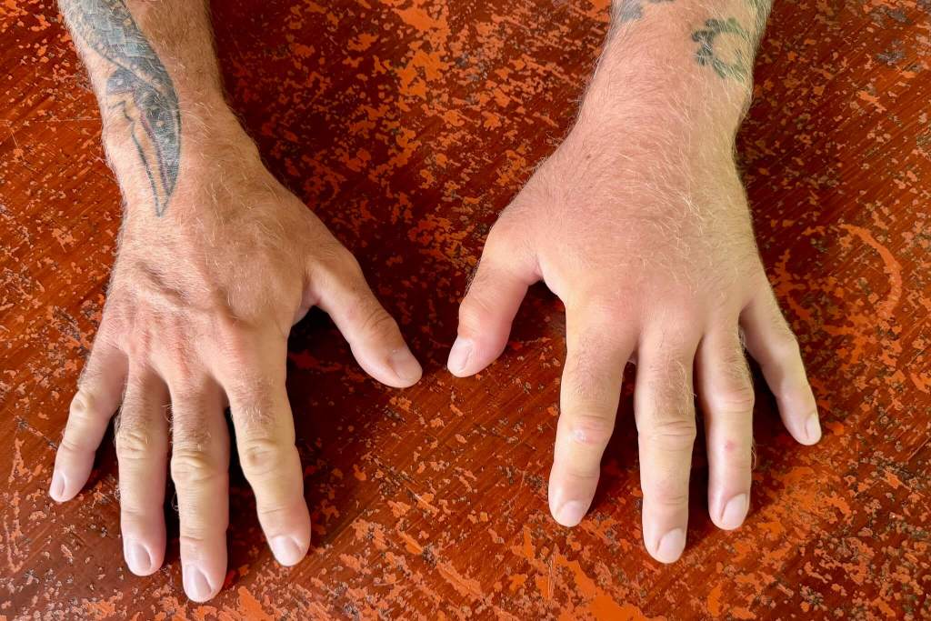 Comparing swollen hand to other hand after a lionfish envenomation
